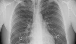 ¿Te recuperaste de COVID-19? Una revisión médica periódica garantiza la calidad de vida