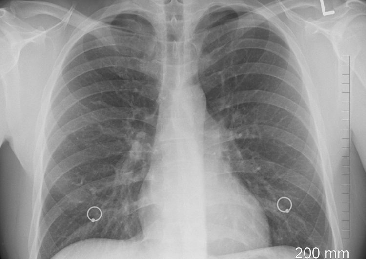 ¿Te recuperaste de COVID-19? Una revisión médica periódica garantiza la calidad de vida