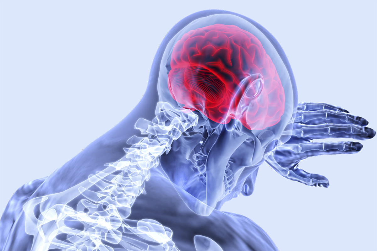 Las secuelas de un derrame cerebral pueden incluir parálisis y problemas de raciocinio, habla y visión. Imagen: VSRao/Pixabay