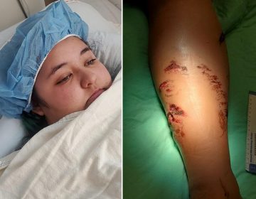 Joven estadounidense es atacada por un cocodrilo en sus vacaciones por playas mexicanas