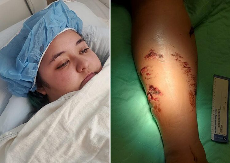 Joven estadounidense es atacada por un cocodrilo en sus vacaciones por playas mexicanas