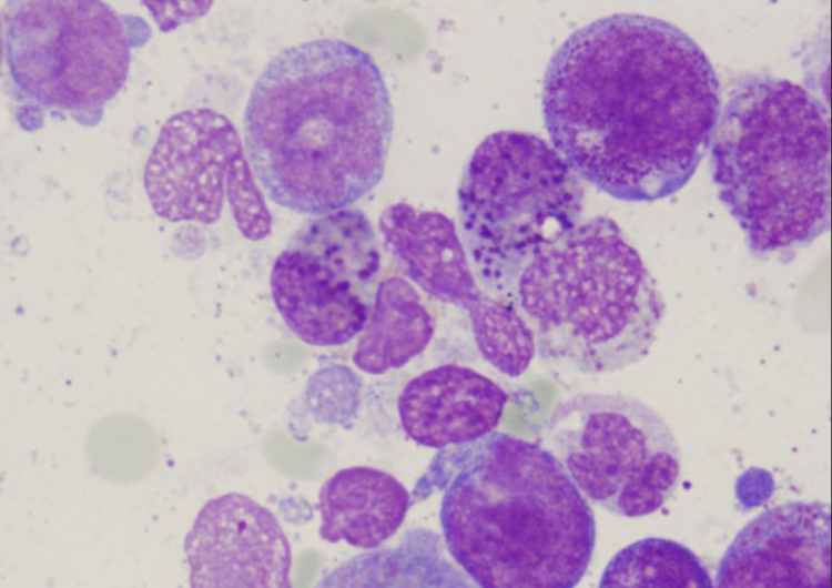 Día Mundial de la Leucemia: en México la enfermedad ocupa el séptimo lugar en mortalidad