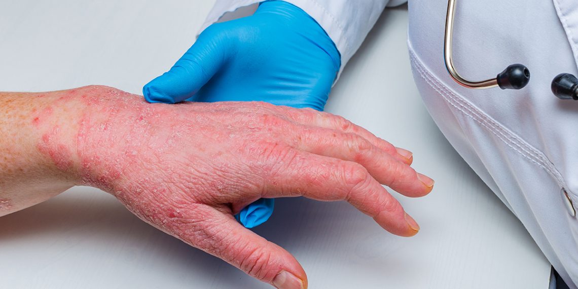 Diversos factores de riesgo pueden llevar a padecerla, como la disfunción de la barrera epidérmica y las alergias. (Foto: Adobe Stock)