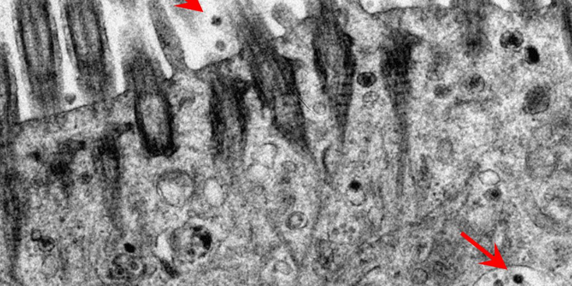 Micrografía electrónica de los tejidos bronquios humanos después de la infección por SARS-CoV-2. (Foto: Universidad de Hong Kong)