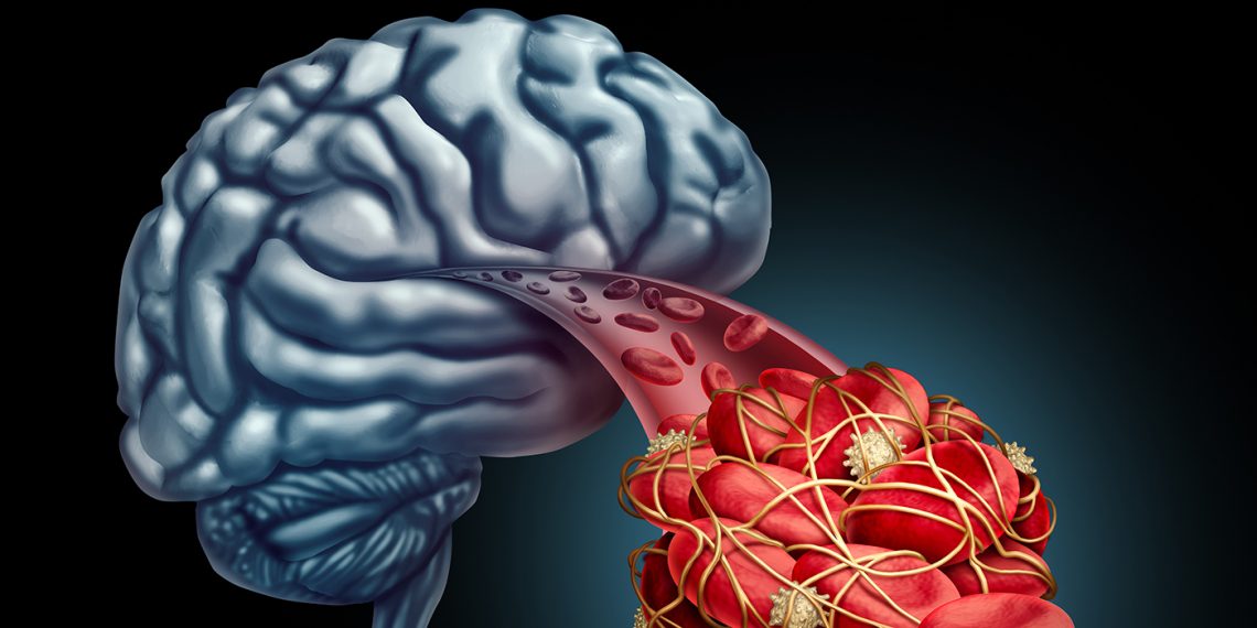 Un infarto cerebral lo produce la formación de placas de ateroma y elevación de colesterol y triglicéridos. La prevención de estos elementos es fundamental. (Imagen: Adobe Stock) 