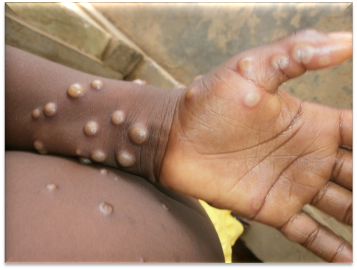 Los primeros síntomas de la viruela del mono incluyen una fuerte fiebre, ganglios linfáticos inflamados y una erupción similar a la varicela. (Foto: OMS)