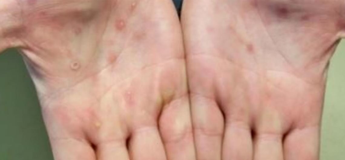 Las lesiones de la viruela del mono suelen aparecer en las palmas de las manos. (Foto: CDC)