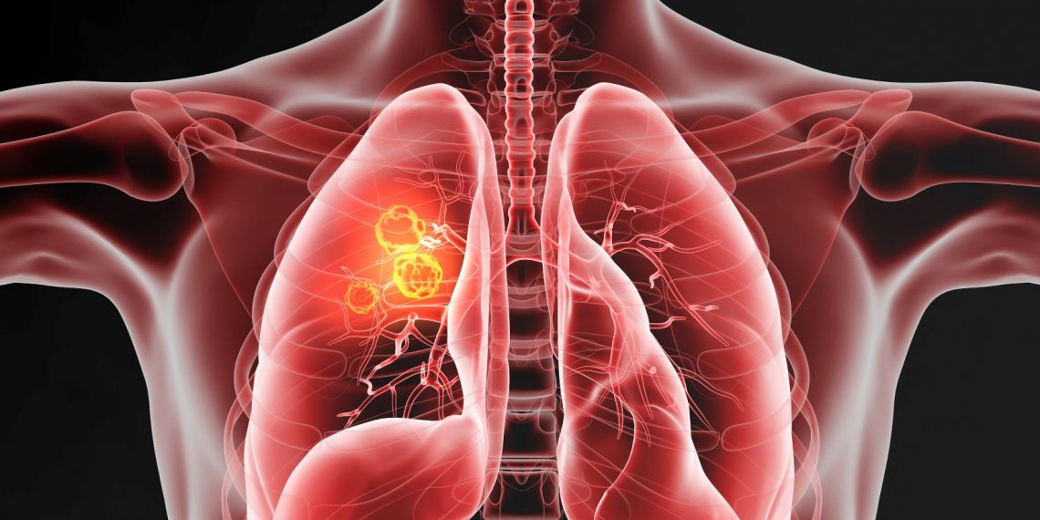 Una de las razones que explica la alta mortalidad del cáncer de pulmón es su característica asintomática, “silenciosa”, en las etapas tempranas, lo que retrasa su detección. (Foto: AdobeStock)