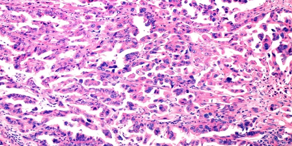 carcinoma mucinoso de ovario