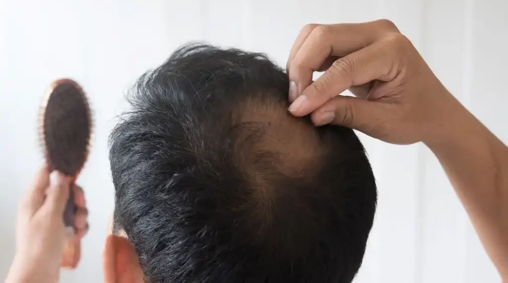 Alopecia hombres