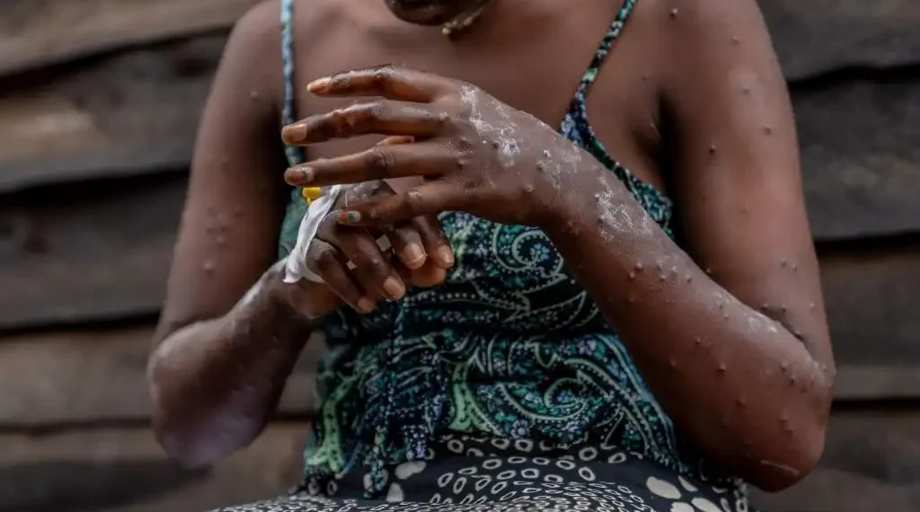 Un paciente con mpox se sienta en un banco en el hospital de Kavumu, a 30 kilómetros al norte de Bukavu, en el este de la República Democrática del Congo. (AFP)