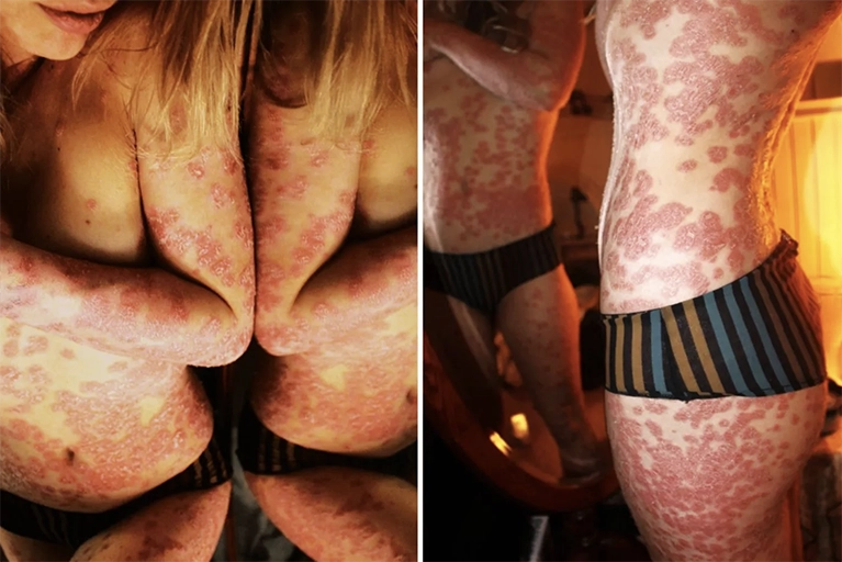 psoriasis