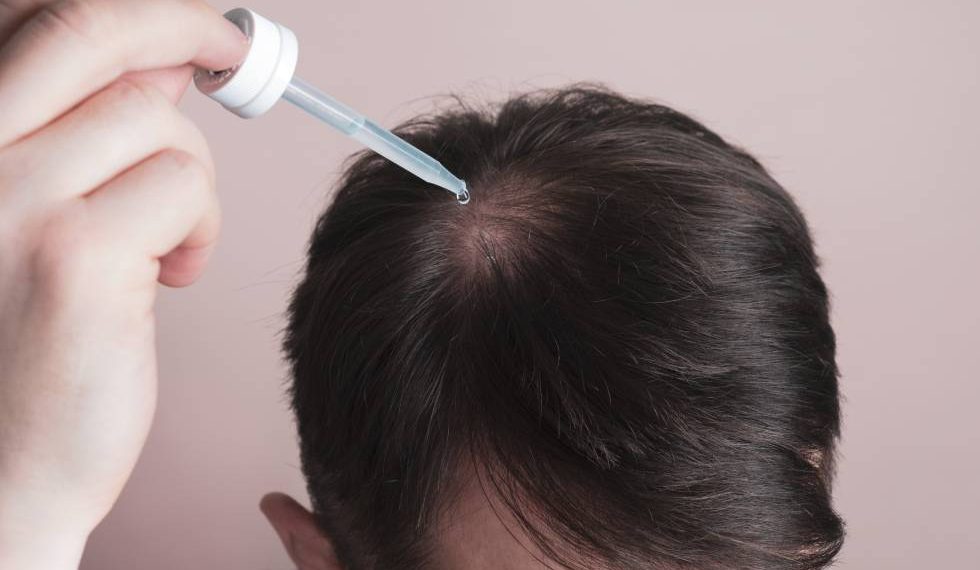 Minoxidil es una sustancia que se usa para combatir la perdida de pelo.