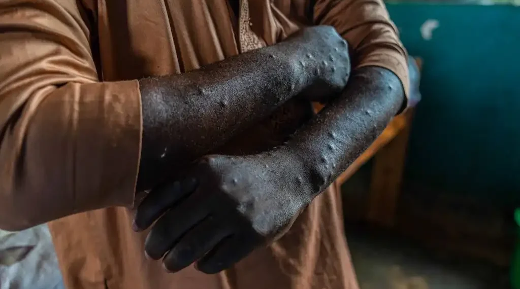 mpox