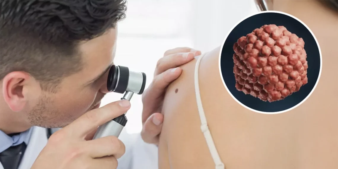 herpes cáncer